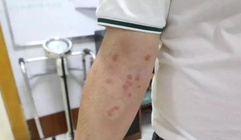 富川人 警惕红火蚁来袭,贺州已有十几人被咬伤入院